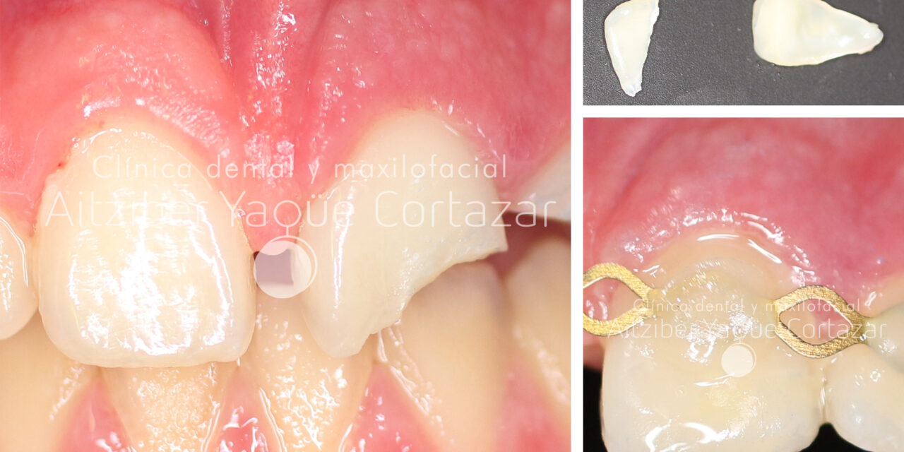 https://aitziberyaguecortazar.com/wp-content/uploads/2019/03/blog-que-hacer-cuando-se-rompe-diente-clinica-dental-maxilofacial-aitziber-yague-cortazar-soria-1280x640.jpg