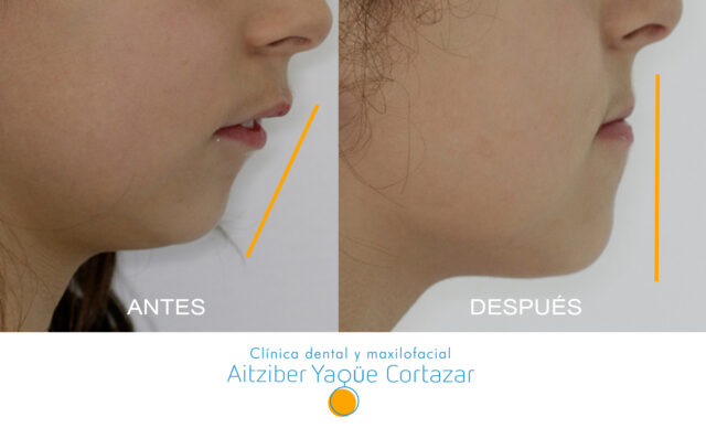 Avance Mandibular En Niños Clínica Dental Maxilofacial Aitziber Yagüe Cortázar