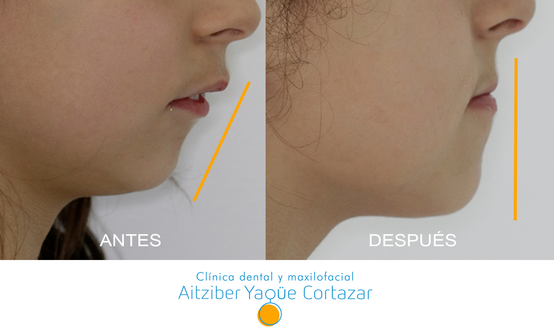 Tratamiento mandibular en niños - Aitziber Yagüe Cortázar