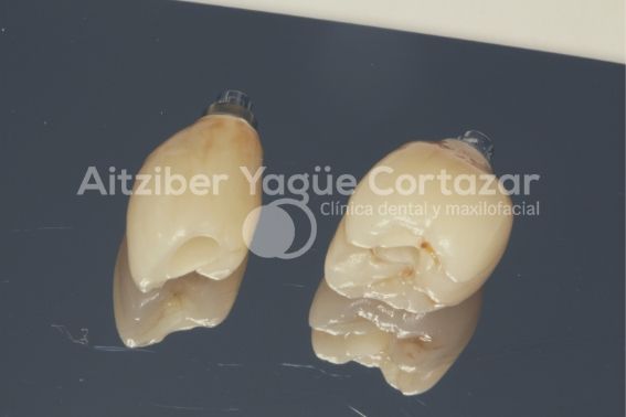 Coronas Monoliticas Oxido Zirconio 1 Clínica Dental Maxilofacial Aitziber Yagüe Cortázar