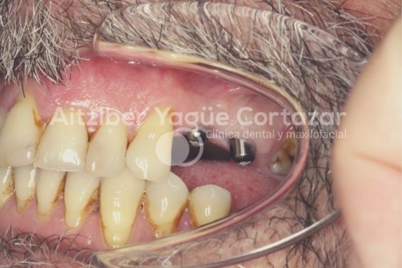 Coronas Monoliticas Oxido Zirconio 2 Clínica Dental Maxilofacial Aitziber Yagüe Cortázar