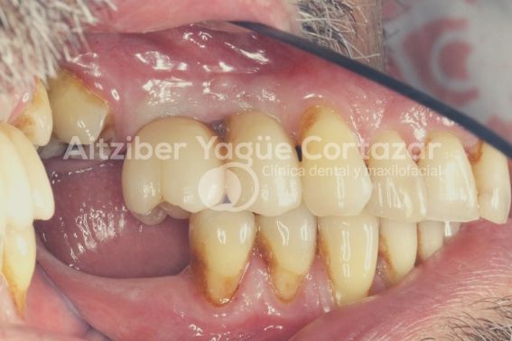 Coronas Monoliticas Oxido Zirconio 3 Clínica Dental Maxilofacial Aitziber Yagüe Cortázar