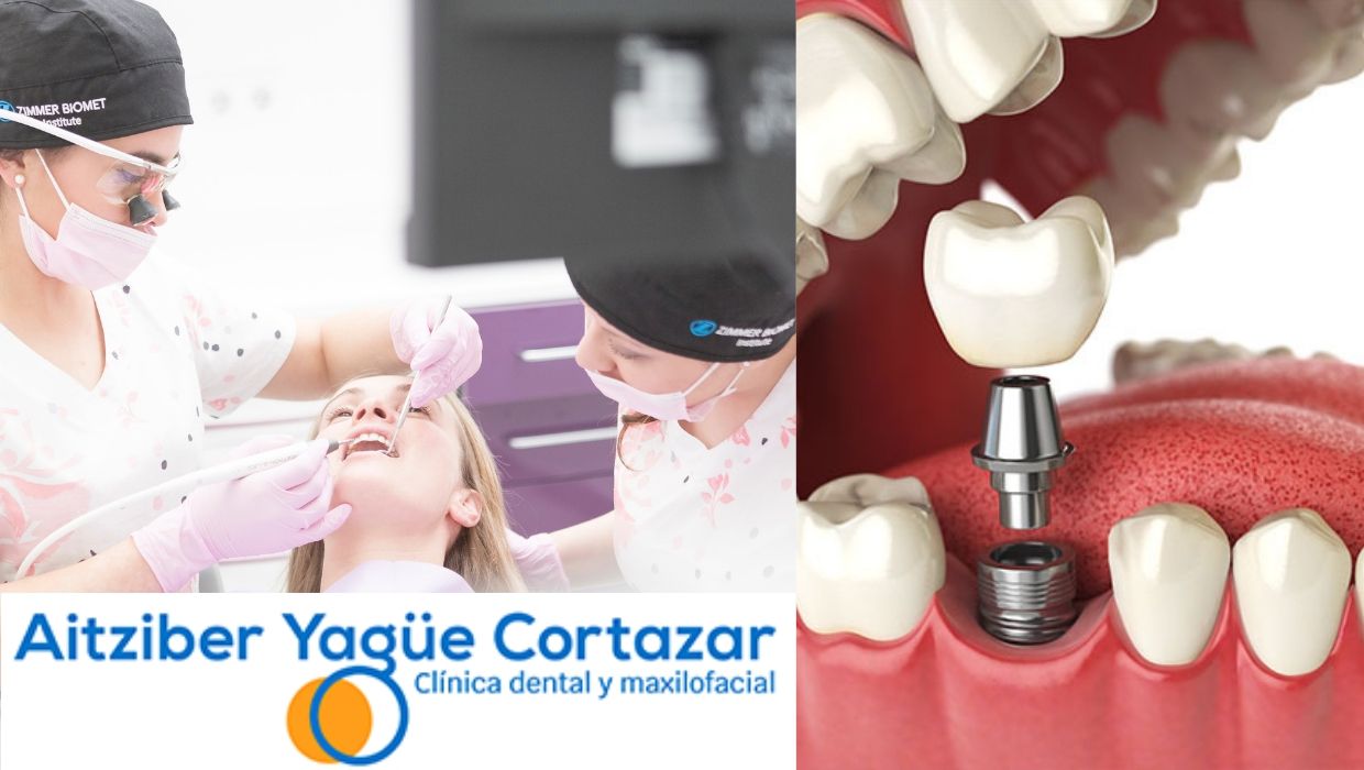 https://aitziberyaguecortazar.com/wp-content/uploads/2021/01/implantologia-dental-mitos-soria-odontologia-aitziber.jpg