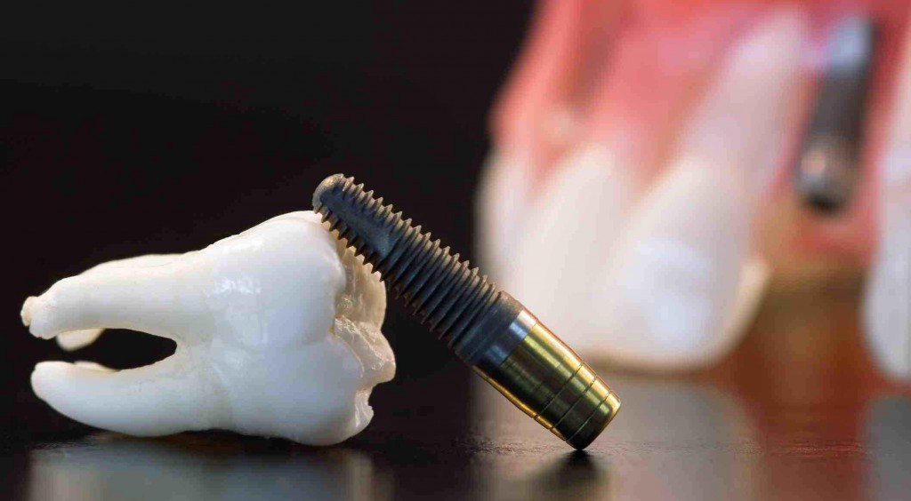 Implantes dentales: recupera la estética y funcionalidad de tu boca