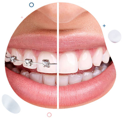 Ortodoncia convencional Metal Clínica Dental Aitziber Yagüe Soria