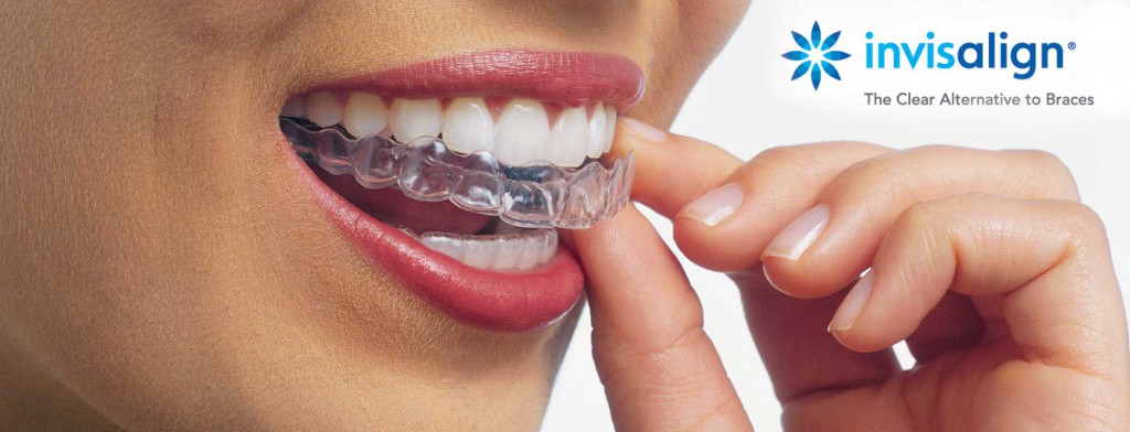 https://aitziberyaguecortazar.com/wp-content/uploads/2022/05/blog-brackets-invisalign-aparato-dientes-transparente-clinica-dental-maxilofacial-aitziber-yague-cortazar-soria.jpg