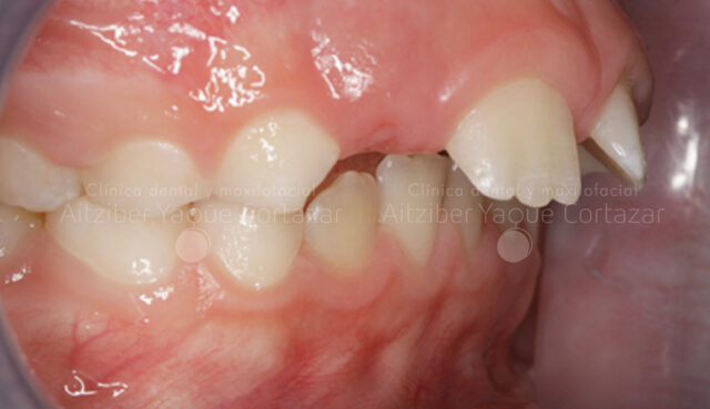 Caso Propio Ortodoncia 1 Clínica Dental Maxilofacial Aitziber Yagüe Cortázar