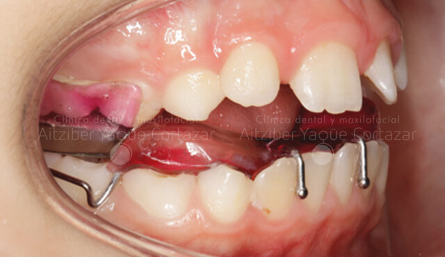 Caso Propio Ortodoncia 2 Clínica Dental Maxilofacial Aitziber Yagüe Cortázar