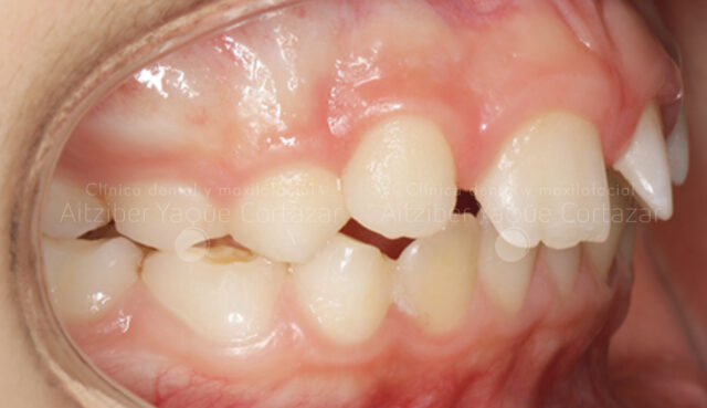 Caso Propio Ortodoncia 3 Clínica Dental Maxilofacial Aitziber Yagüe Cortázar