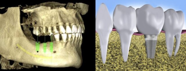 Representación Implante Óseo Clínica Dental Maxilofacial Aitziber Yagüe Cortázar