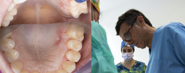 Implante Óseo Clínica Dental Maxilofacial Aitziber Yagüe Cortázar