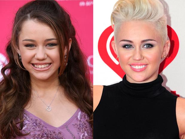 Miley Cyrus Ortodoncia Blanqueamiento Dental Clínica Dental Maxilofacial Aitziber Yagüe Cortázar