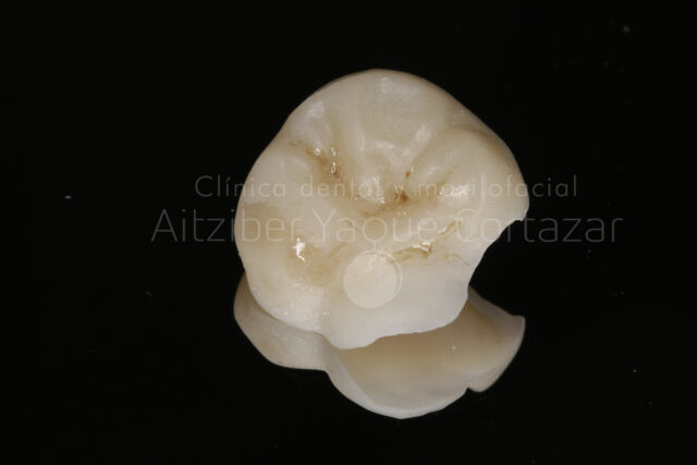 Odontología Digital Corona Clínica Dental Maxilofacial Aitziber Yagüe Cortázar
