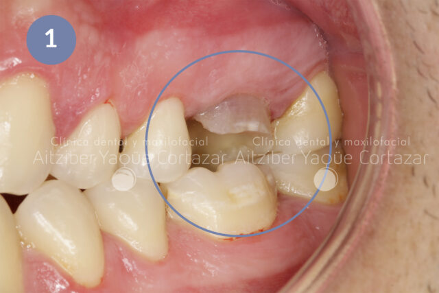 Protesis Dental 3d 1 Clínica Dental Maxilofacial Aitziber Yagüe Cortázar