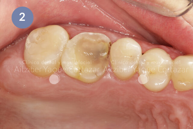Protesis Dental 3d 2 Clínica Dental Maxilofacial Aitziber Yagüe Cortázar
