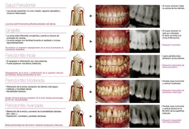 Tipos Periodontal Clínica Dental Maxilofacial Aitziber Yagüe Cortázar