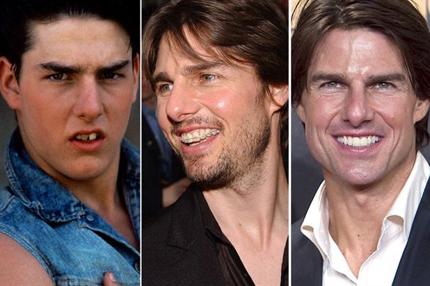 Tom Cruise Carillas Ortodoncia Blanquemiento Dental Clínica Dental Maxilofacial Aitziber Yagüe Cortázar