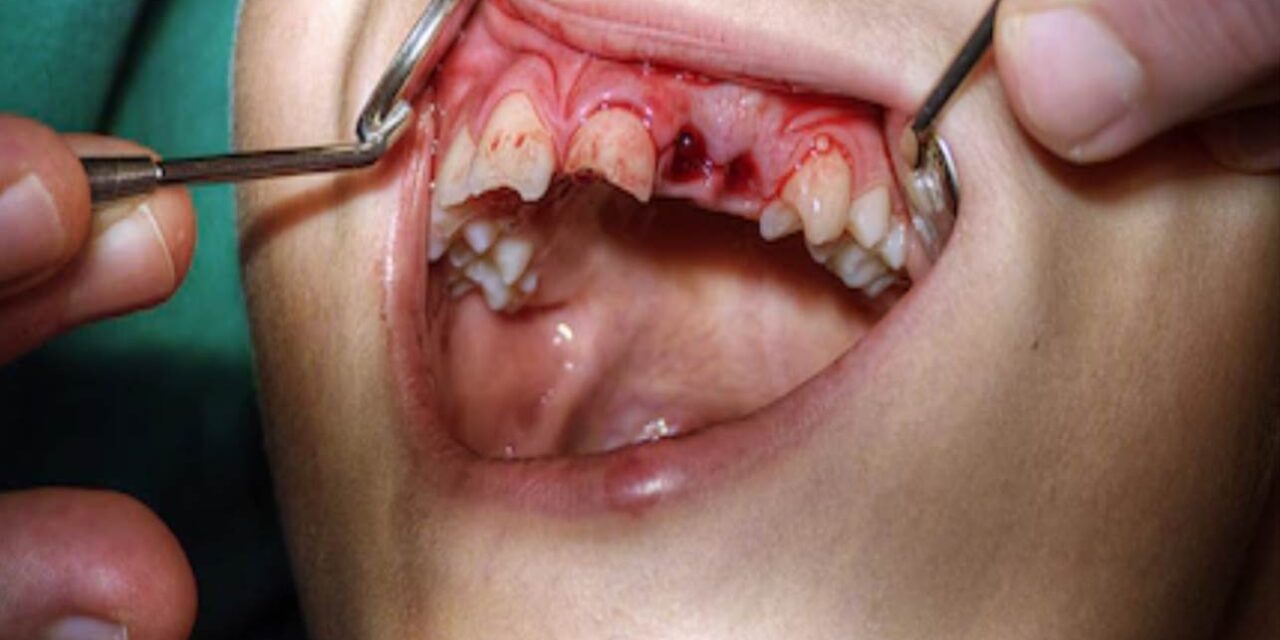 Romperse la boca o partirse los dientes… ¿has sufrido algún traumatisto dental?