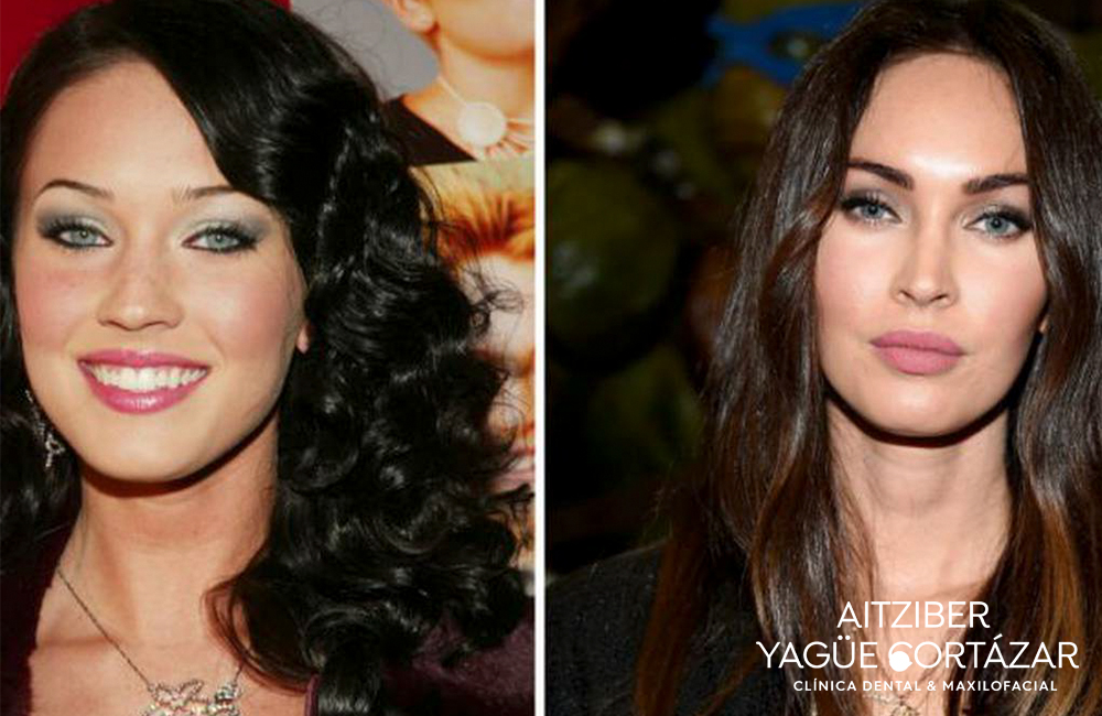 Megan Fox, antes y después de su Bichectomía