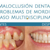 Caso Mordida clase 3 Clínica dental y maxilofacial Aitziber Yagüe Cortázar en Soria