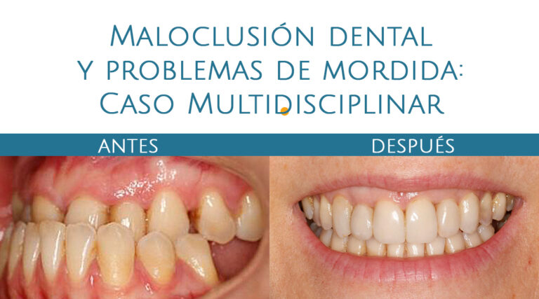 Caso Mordida clase 3 Clínica dental y maxilofacial Aitziber Yagüe Cortázar en Soria