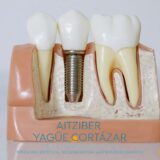 Implante dental en Clínica Dental y Maxilofacial Aitziber Yagüe Cortázar