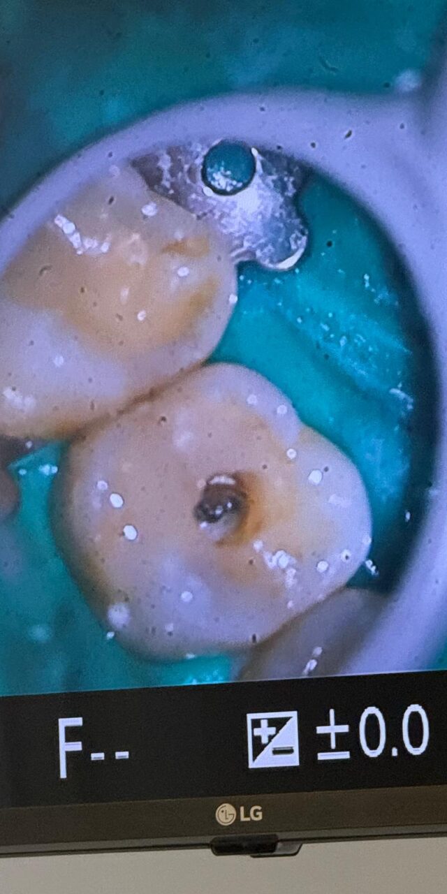 tratamiento-de-endodoncia-soria (2)