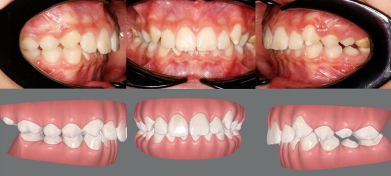 antes-y-despues-tratamiento-ortodoncia (1)