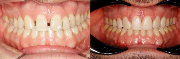 antes-y-despues-tratamiento-ortodoncia (10)