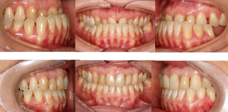 antes-y-despues-tratamiento-ortodoncia (11)