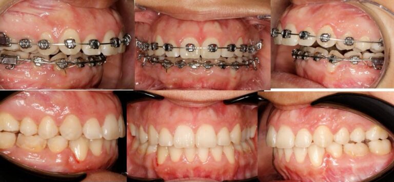 antes-y-despues-tratamiento-ortodoncia (12)