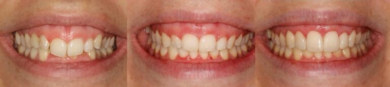 antes-y-despues-tratamiento-ortodoncia (13)