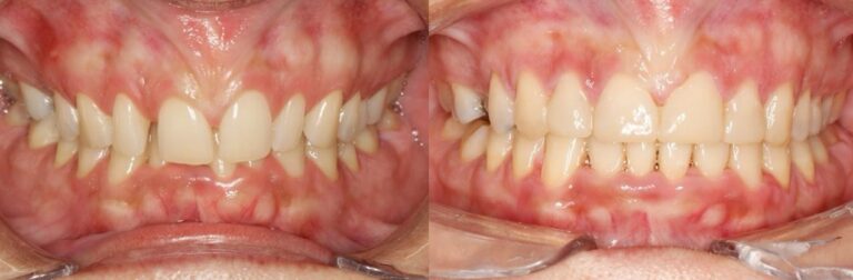 antes-y-despues-tratamiento-ortodoncia (14)