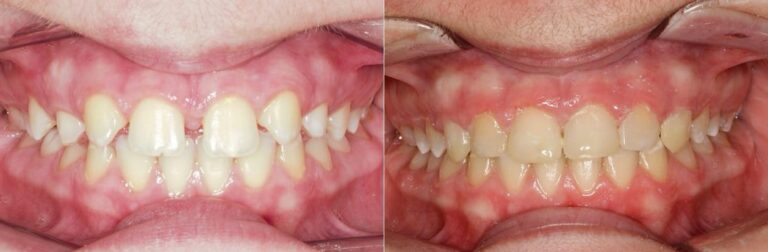 antes-y-despues-tratamiento-ortodoncia (2)
