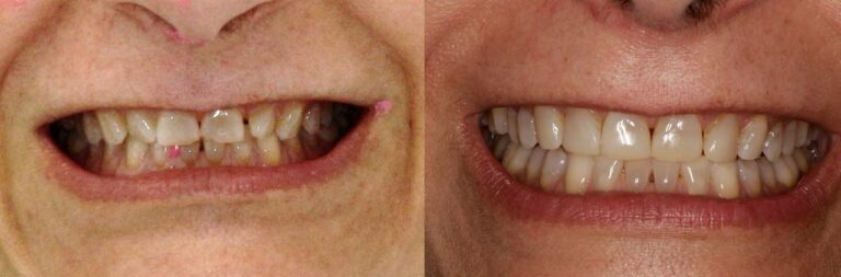 antes-y-despues-tratamiento-ortodoncia (3)