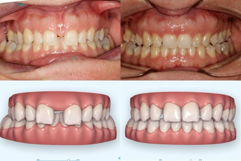 antes-y-despues-tratamiento-ortodoncia (4)