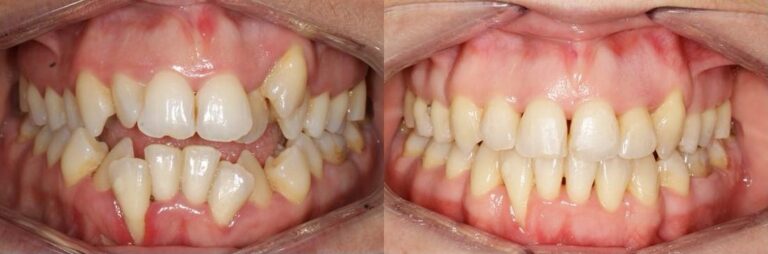 antes-y-despues-tratamiento-ortodoncia (6)