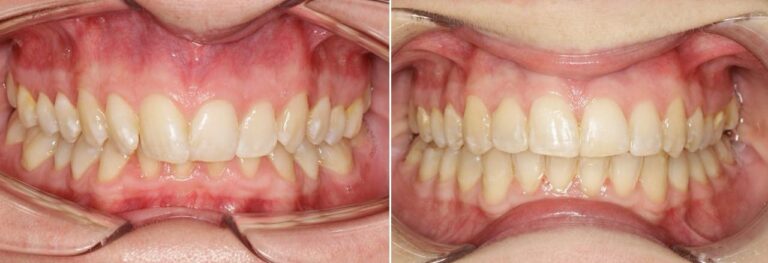 antes-y-despues-tratamiento-ortodoncia (7)
