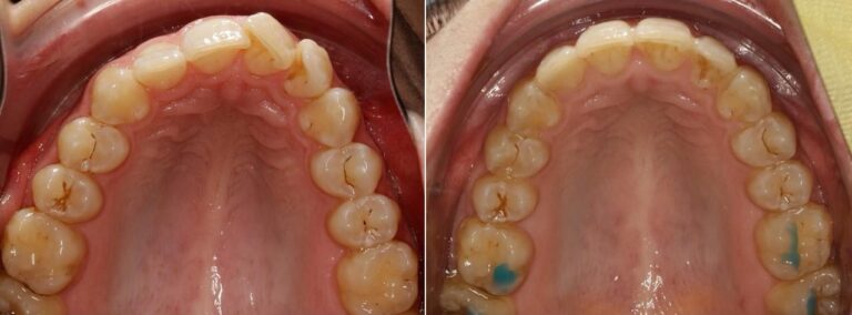 antes-y-despues-tratamiento-ortodoncia (8)