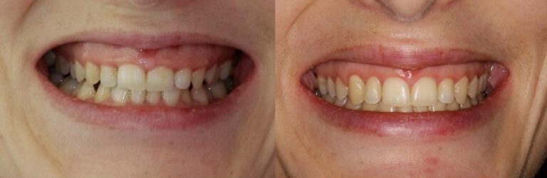 antes-y-despues-tratamiento-ortodoncia (9)